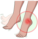 Physiotherapy for Foot Drop Link