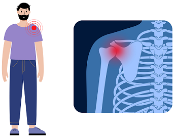 Shoulder Dislocation Physiotherapy